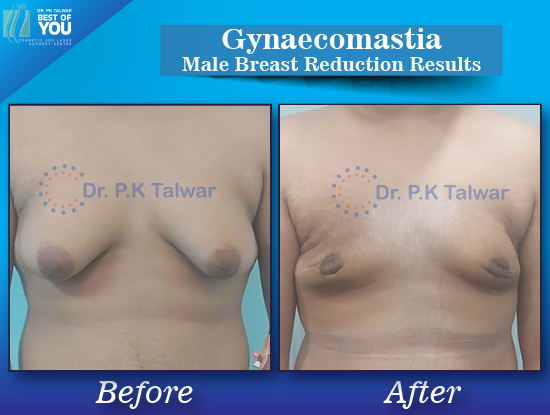 Gynaecomastia before after image